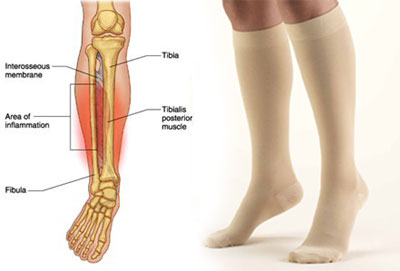 Compression Socks for Shin Splints
