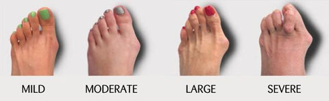 bunions feet severity scale from small to big 