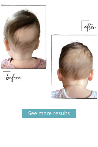 Baby hair loss my daughter looks like a 80 year old man  August 2019  Babies  Forums  What to Expect