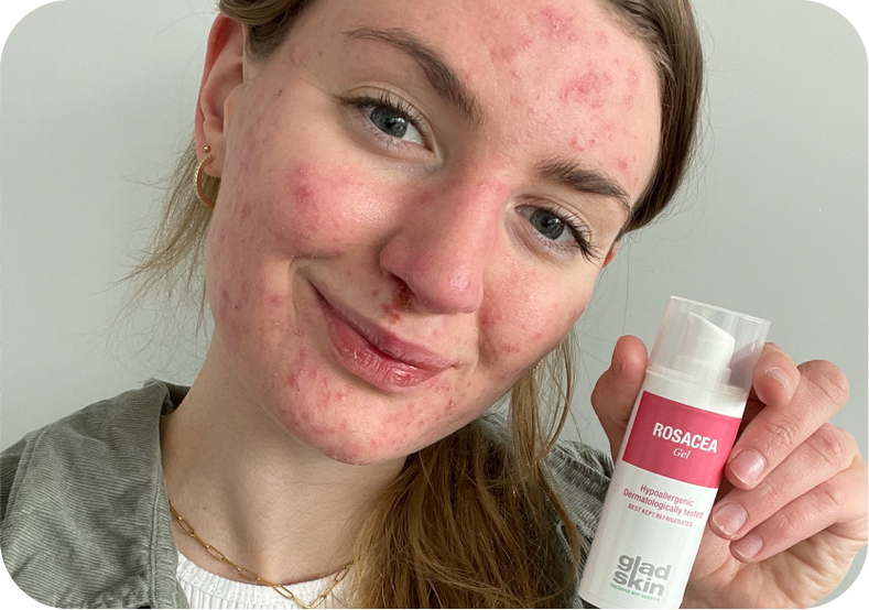 SKIN JOURNEY: Mina’s shares her experience with Acne and Rosacea