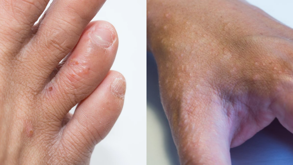 dyshidrotic eczema, hand dermatitis on toes and hand