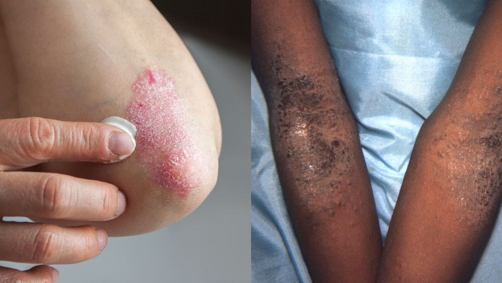 neurodermatitis, eczema, on fair skin and dark, melanated skin