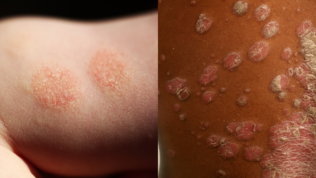 nummular dermatitis, eczema, on fair skin and dark, melanated skin