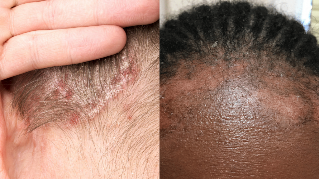 seborrheic dermatitis, eczema, on fair skin hairline and dark skin hairline
