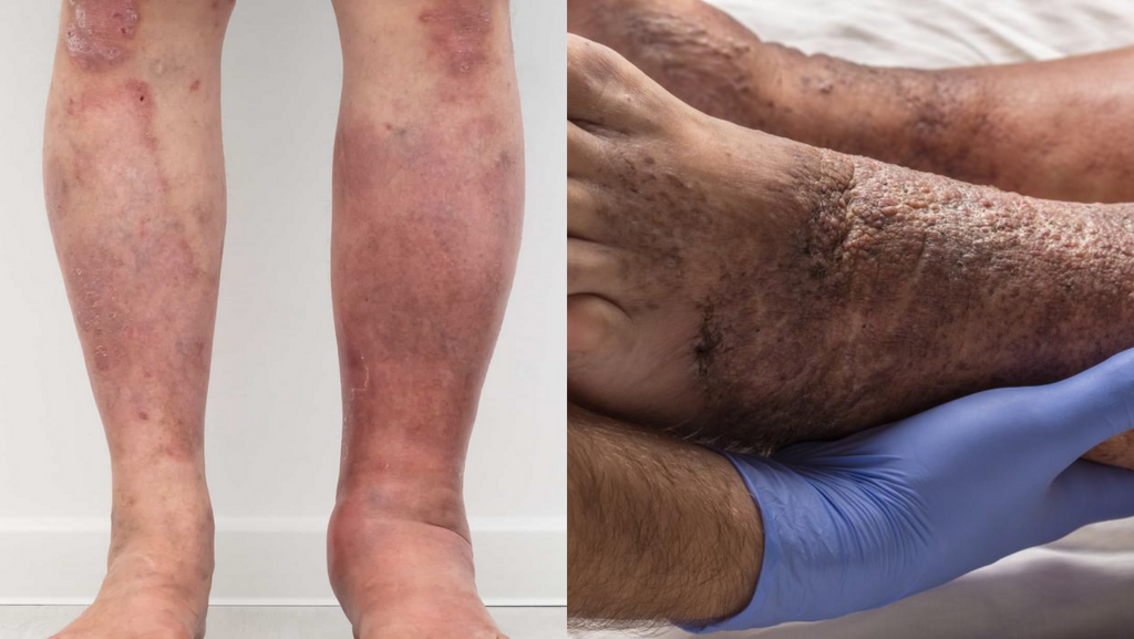 stasis dermatitis gravitational dermatitis, eczema, on fair skin legs and dark skin legs