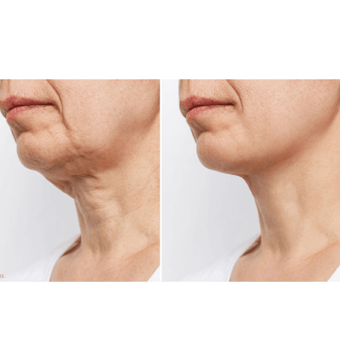 Ageing and the Neck