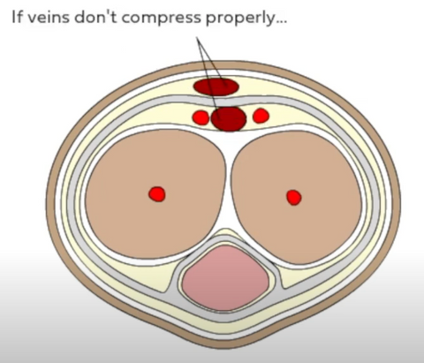 Cross section of penis - veins don't compress properly