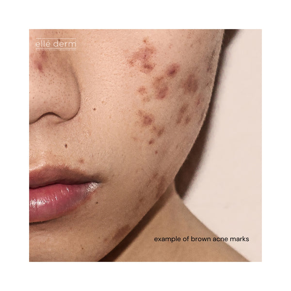 brown acne marks