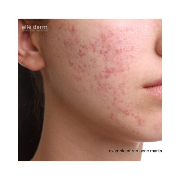 red acne marks