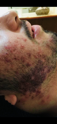 Photo of cystic acne
