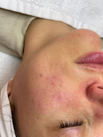 Photo of grade V rashy acne