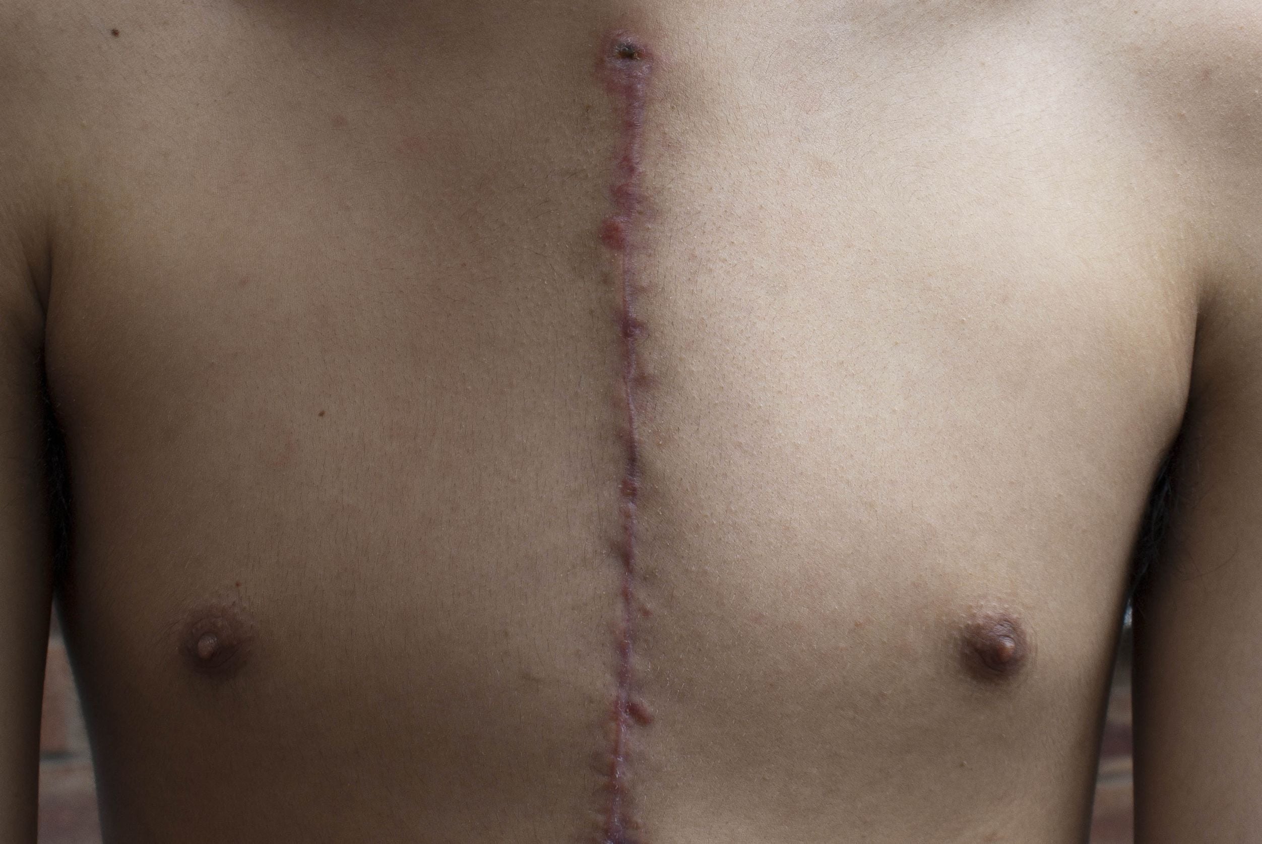 Typical heart surgery scar