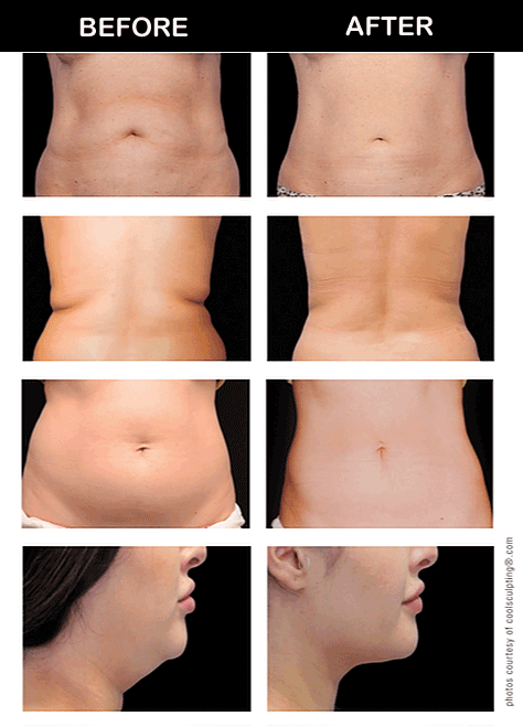 Comparing Body Contouring Techniques