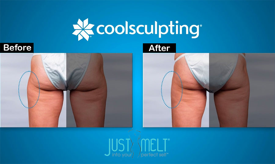 Results to Expect from CoolSculpting Body Contouring Treatment - Just Melt  Med Spa