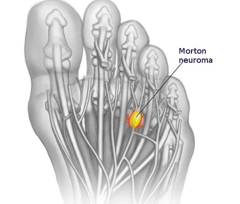 An illustration of a Mortons neuroma on a foot