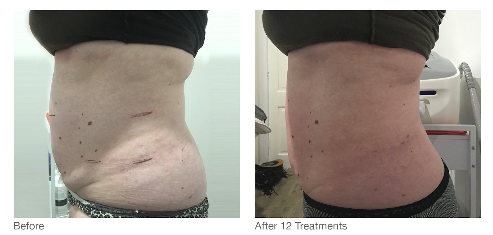 cavitation for cellulite reduction