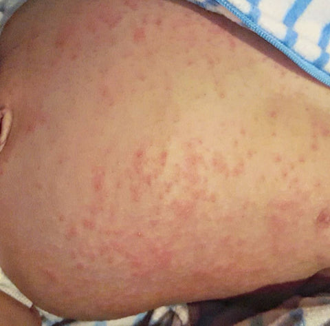 Baby eczema on belly