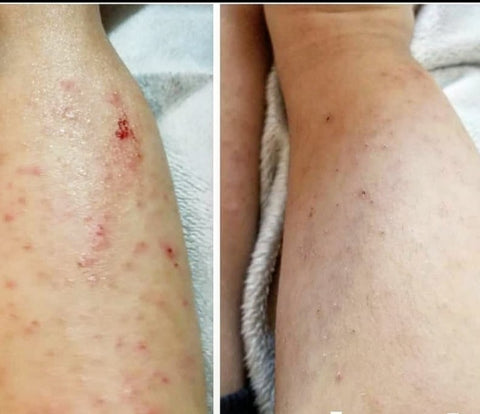 Baby eczema on legs