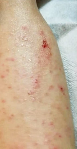 Baby eczema on one leg