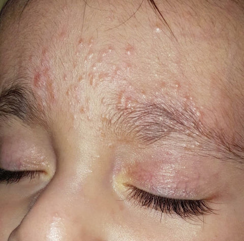 Baby eczema on face