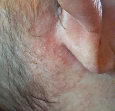 baby eczema on scalp and behind ears