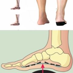 semelles-orthopédiques-pour-pieds-plats