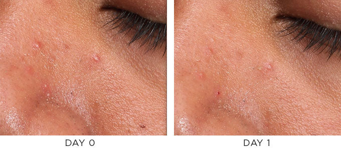 Before and after image showing improvement in acne