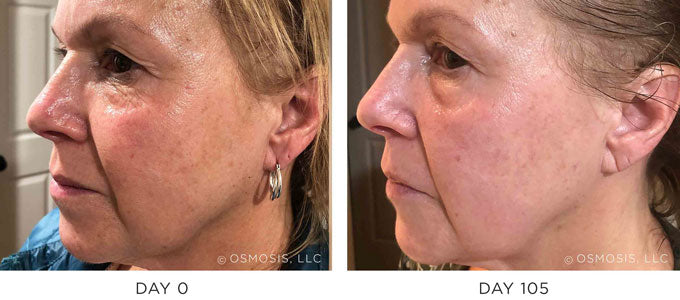 Before and After Results Showing Improvement in Aging Wrinkles and Sagging Skin