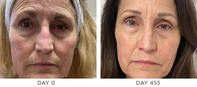 Before and after image showing improvement in the appearance of aging skin