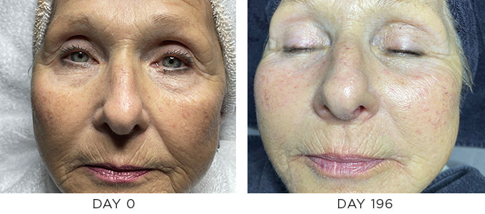 Wrinkles and Fine Lines Before and After Results Showing Improvement