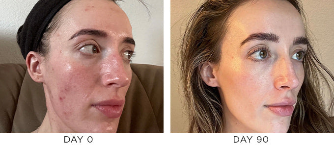 Before and after image showing improvement in cystic hormonal acne