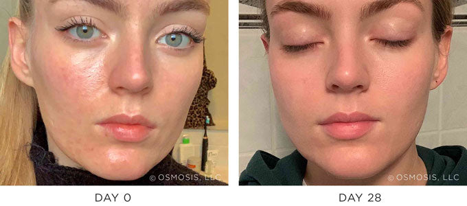 Before & After Results Showing Improvement in Acne