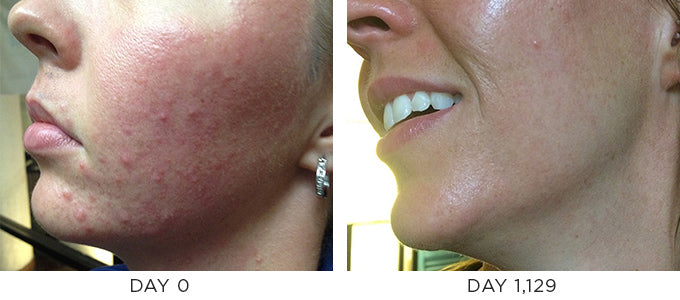 Before and After Results showing improvement in blemishes