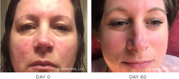 Before and After results showing improvement of blemish-prone and oily skin