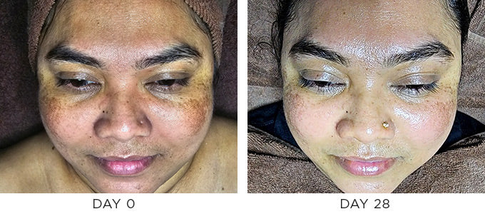 Before and after image showing improvement in the appearance of melasma