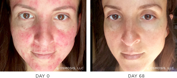 Before and After results showing improvement of blemish-prone and oily skin