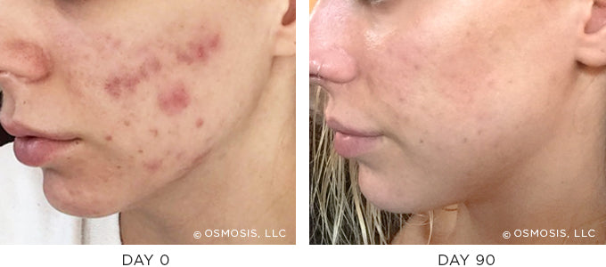 Before and After results showing improvement of blemish-prone and oily skin