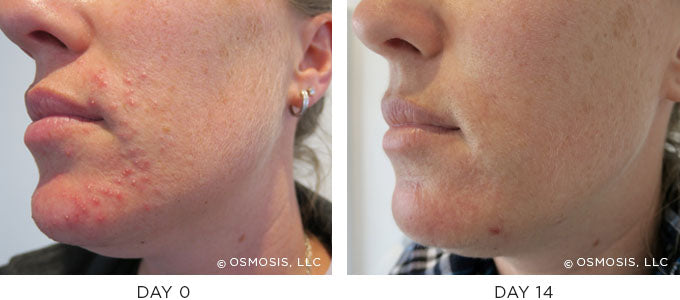 Before and After results showing improvement of blemish-prone and oily skin