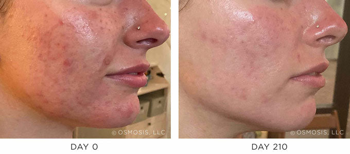 Before and After Results showing improvement in Acne