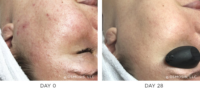 Before and After results showing improvement of blemish-prone and oily skin