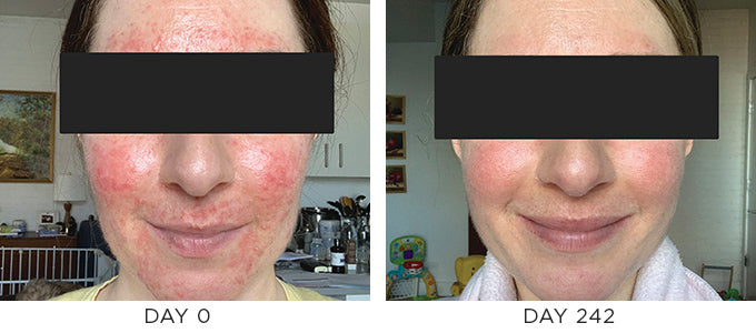 redness before and after