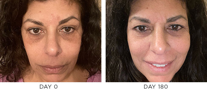 Before and after image showing improvement in the appearance of hyperpigmentation