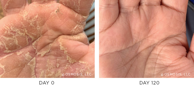 Eczema Psoriasis Before and After – Osmosis Beauty