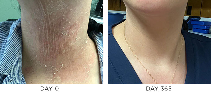 Before and After Result showing improvement in a red irritated neck rash