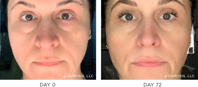 Osmosis recovery before and after
