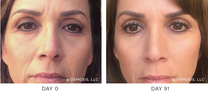 Before and After Client with improvement in frown lines, nasal labial folds, marionette lines