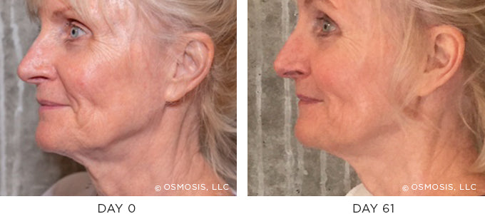 Before and After Client with improvement in the eyes, marionette lines, jowls and neck - Recovery Beauty From the Inside-Out