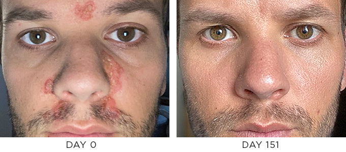 Before and After image showing improvement in seborrheic dermatitis