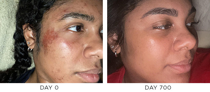Before and After showing improvement in wound repair pigmentation and blemishes