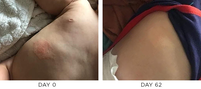 Before and After showing improvement in rash